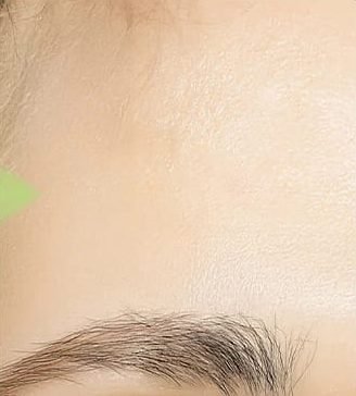 Forehead skin after: smoother, even texture