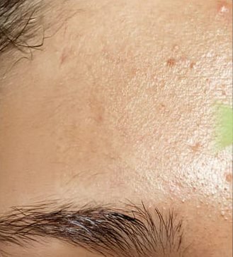 Forehead skin before: bumps and uneven texture
