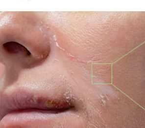 Dry, flaking skin around the mouth